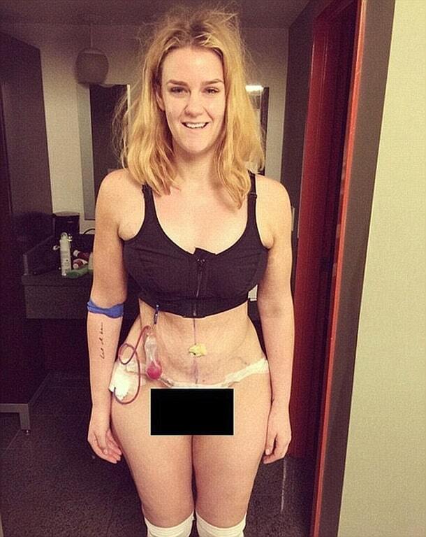Похудевшая на 92 кг девушка показала фигуру после торсопластики: поразительные фото