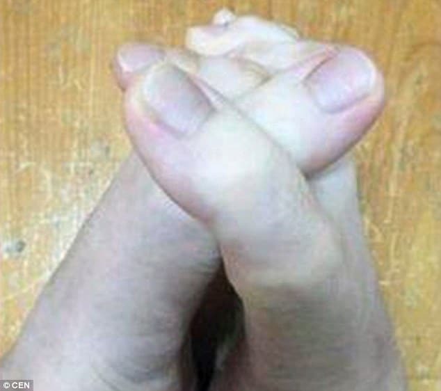 Тайванка удивила снимком аномально длинных пальцев на ногах