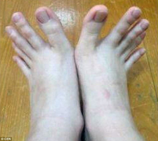 Тайванка удивила снимком аномально длинных пальцев на ногах