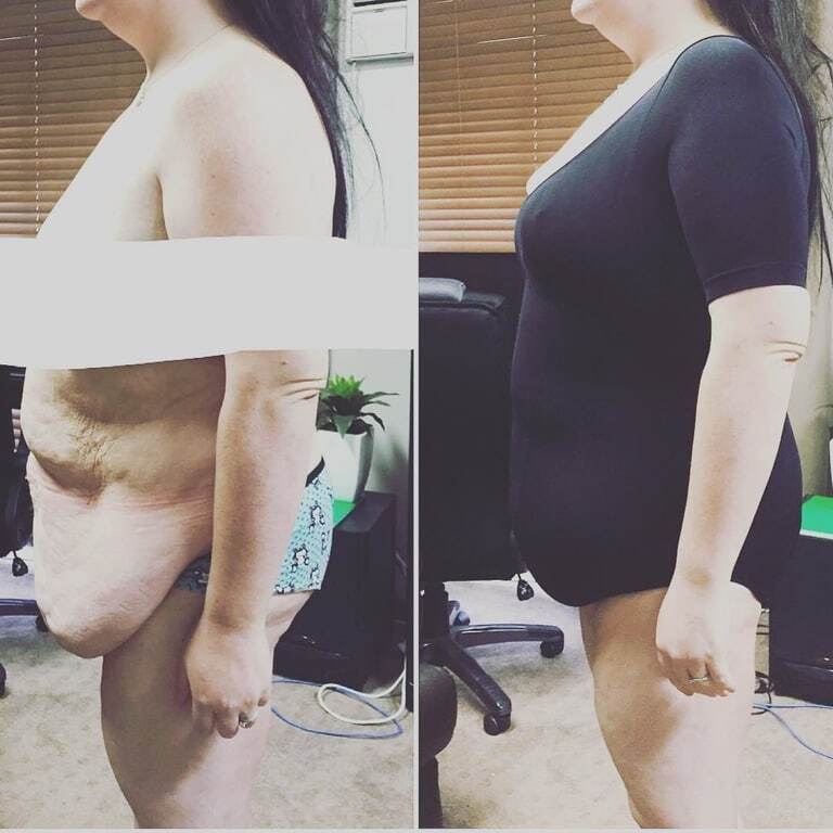 Невероятная сила духа: страдающие от ожирения супруги из Австралии на двоих сбросили 172 кг