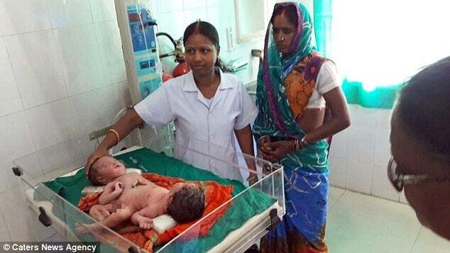 В Індії жінка народила сіамських близнюків з однією парою ніг
