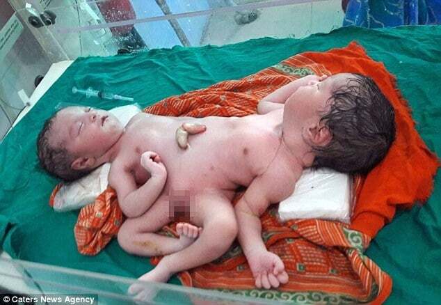"Мое сердце разбито": в Индии женщина родила сиамских близнецов с одной парой ног. Фотофакт