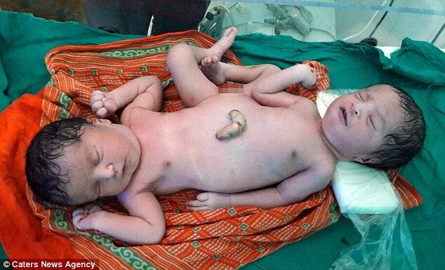 "Мое сердце разбито": в Индии женщина родила сиамских близнецов с одной парой ног. Фотофакт