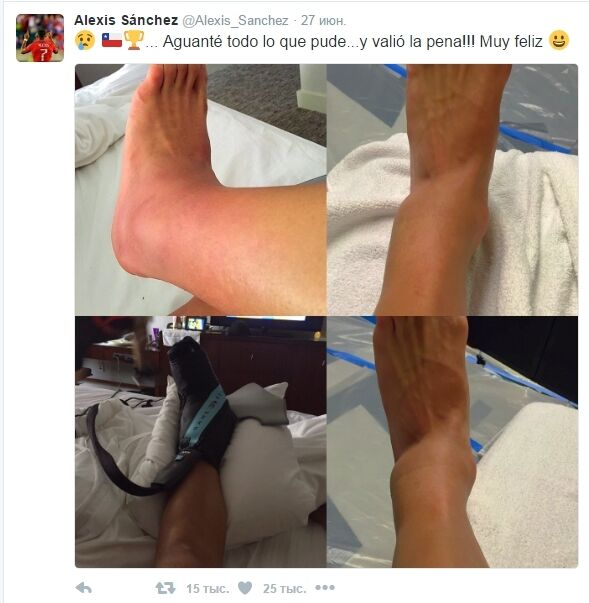 Футболист "Арсенала" показал ногу после ужасной травмы в финале Копа Америка
