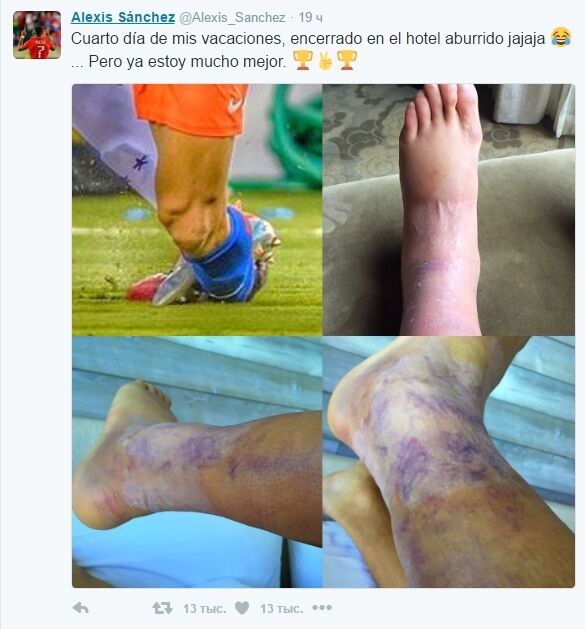 Футболист "Арсенала" показал ногу после ужасной травмы в финале Копа Америка