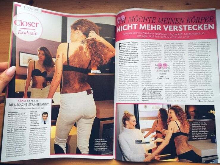 Необычная красота: украинка с тысячью родинок на теле стала звездой сети