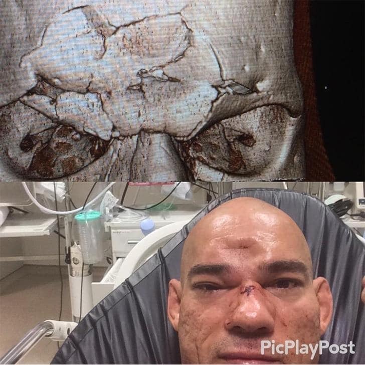 Бойцу ММА во время поединка коленом проломили череп: фото не для слабонервных