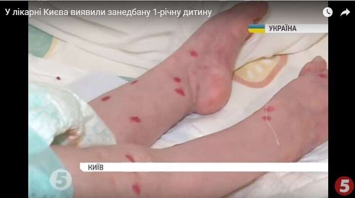 Кровавые раны и сантиметровые ногти: в больнице Киева нашли ребенка в ужасном состоянии