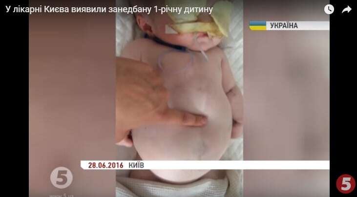 У лікарні Києва знайшли дитину в жахливому стані