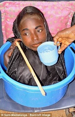 У Нігерії дівчина з тілом немовляти 19 років живе у мисці