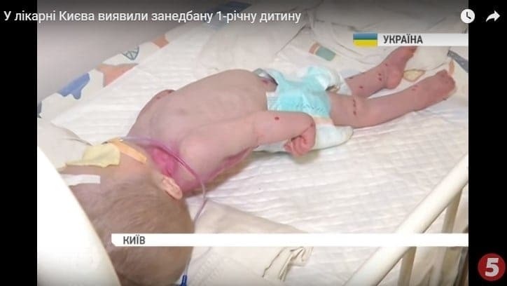 Соберем деньги для Светочки: как облегчить муки сироты, оставшейся без присмотра в киевской больнице