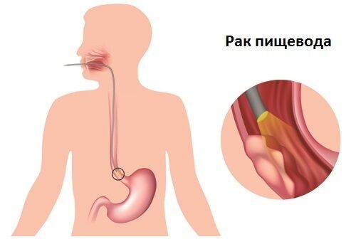 Болезни пищевода: как отличить от проблем с сердцем