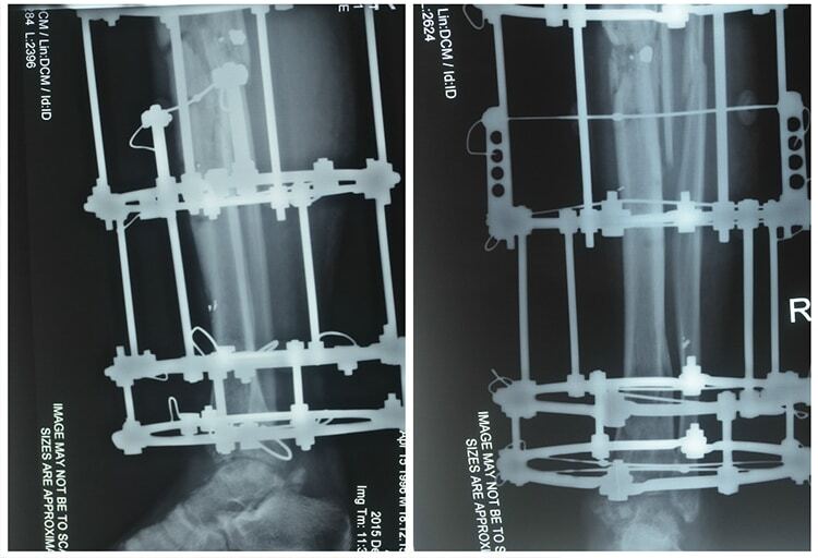Ранили под Песками: украинские врачи-биотехнологи восстановили ногу 19-летнего добровольца. Опубликованы фото