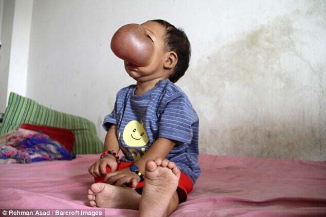 Врачи попытаются помочь ребенку с огромной опухолью на лице: шокирующие фото