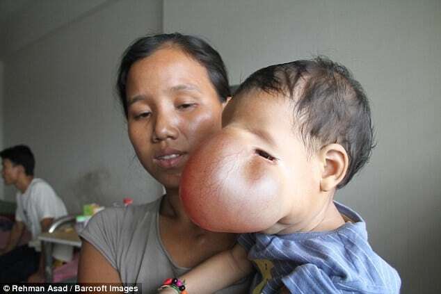 Врачи попытаются помочь ребенку с огромной опухолью на лице: шокирующие фото