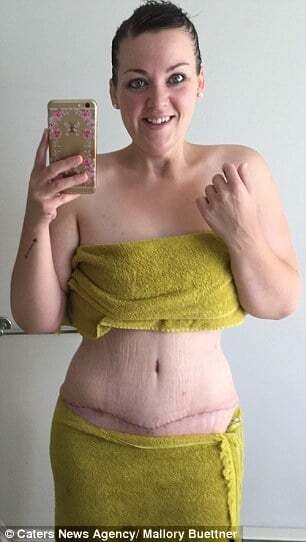 Похудевшая на 100 кг канадка впервые в жизни надела бикини: поразительные фото