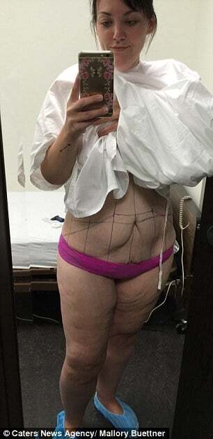 Похудевшая на 100 кг канадка впервые в жизни надела бикини: поразительные фото