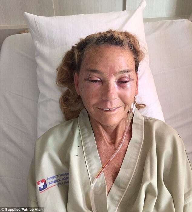 "Дочь Франкенштейна" из Австралии невероятно преобразилась после операции в Таиланде: опубликованы фото