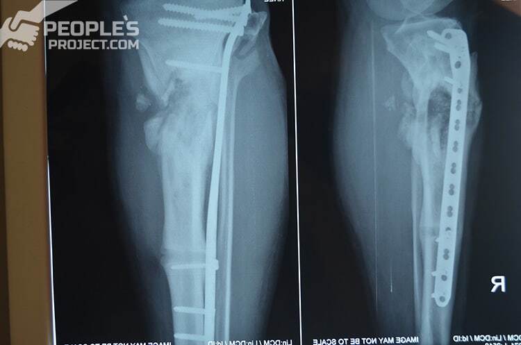 Дивовижне зцілення: боєць АТО, який майже втратив ногу, ходить на власних двох
