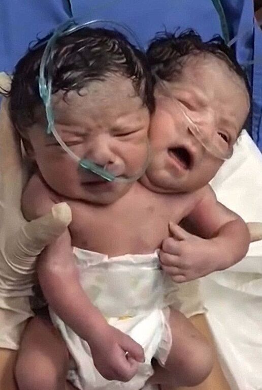 Сеть поразило видео с новорожденным двухголовым ребенком из Мексики