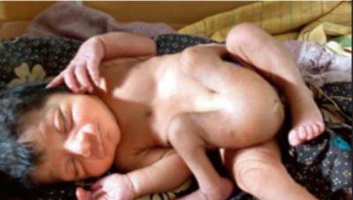 Ужасная мутация: в Индии родился четырехногий ребенок
