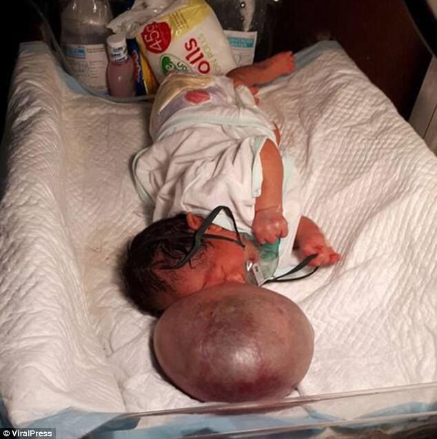 Большой воздушный шар на лице: девочка на Филиппинах родилась с шокирующей патологией