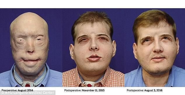 Мужчина, которому полностью пересадили лицо, показал фото ''до'' и ''после''