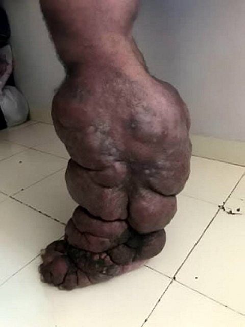 "Паразити в тілі": в Індії знайшли чоловіка з рідкісною хворобою. Моторошні фото 18+