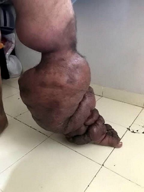 "Паразити в тілі": в Індії знайшли чоловіка з рідкісною хворобою. Моторошні фото 18+