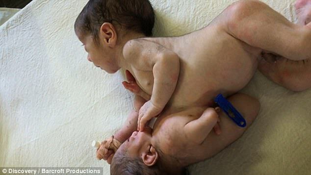В Індії народився малюк із близнюком-паразитом на животі: шокуючі фото