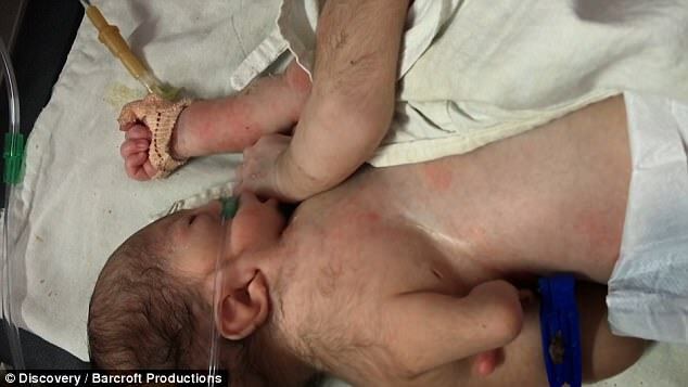 В Индии родился малыш с близнецом-паразитом на животе: шокирующие фото
