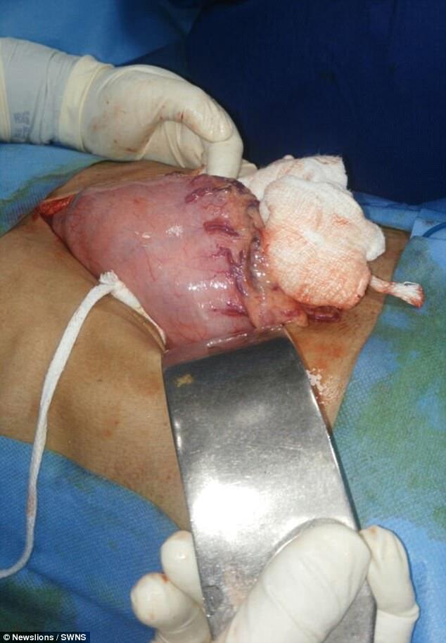 Мужчина проглотил 639 гвоздей: опубликованы шокирующие фото спасения