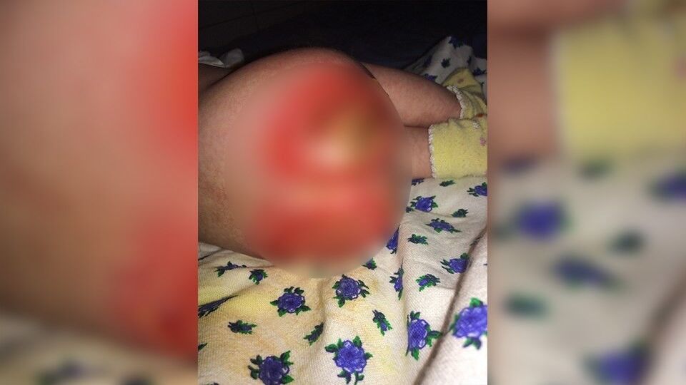 В больнице России чуть не сожгли новорожденную: опубликованы жуткие фото
