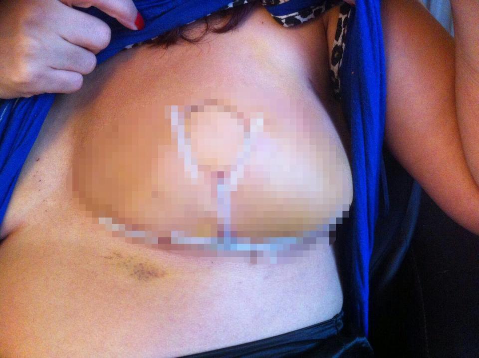 Перепутали: в Великобритании пациентке случайно удалили грудь