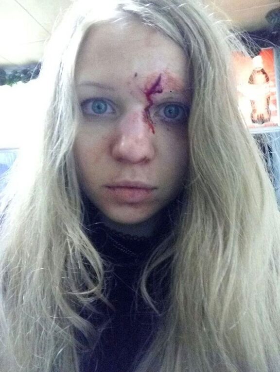 "Те же, кто внес залог": в Киеве избили Виту Заверуху и ее парня. Фотофакт