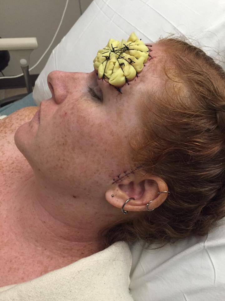 ''Це було пекло'': 39-річна американка оголосила бій меланомі