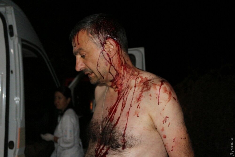 Напали з залізними битами: на Одещині жорстоко побили журналіста