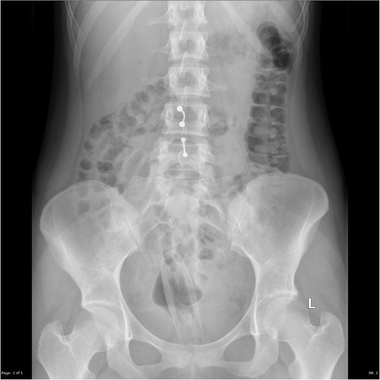 Сексуальные провалы: врачи показали рентген-снимки самых нелепых ситуаций