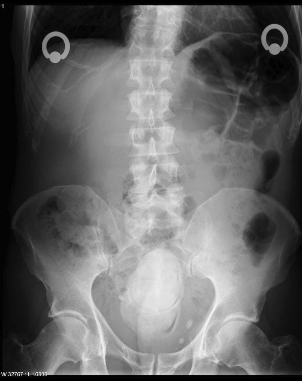Сексуальные провалы: врачи показали рентген-снимки самых нелепых ситуаций