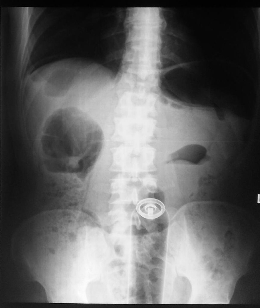 Сексуальні провали: лікарі показали рентген-знімки найбезглуздіших ситуацій