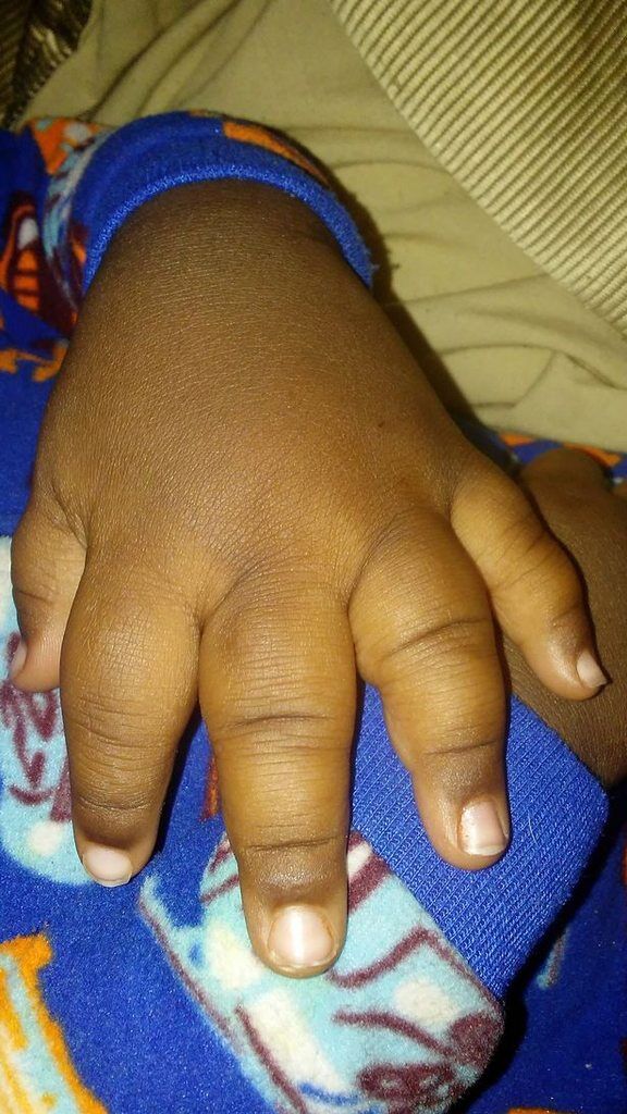 ''Люди сміються, а він може померти'': в США знайшли хлопчика з величезними руками