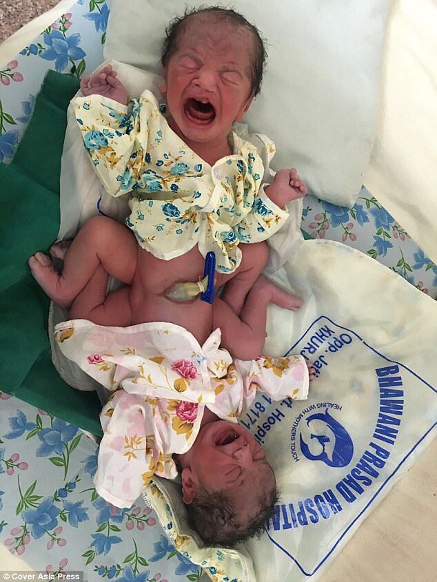В Индии родились сиамские близнецы непонятного пола: опубликованы фото 