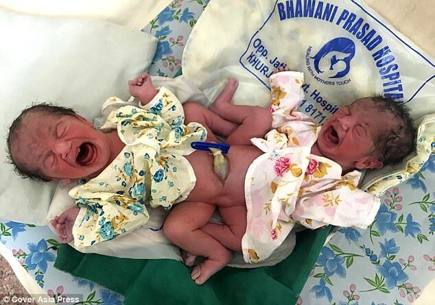 В Індії народилися сіамські близнюки незрозумілої статі: опубліковані фото