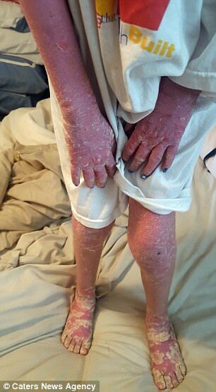 Сдирать кожу, чтобы выжить: 9-летняя девочка страдает от редчайшей болезни 