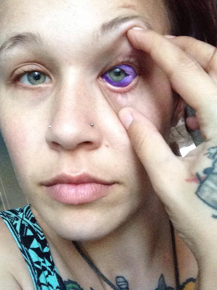Текли фиолетовые слезы: неудачная татуировка изуродовала глаз модели 