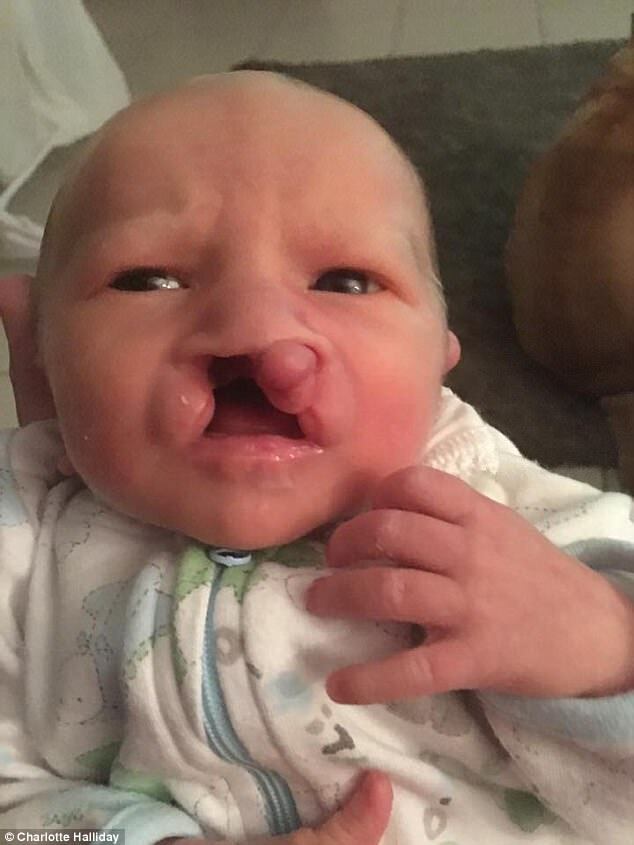 ''Впервые пускает пузыри'': родители малыша с патологией делятся его фото