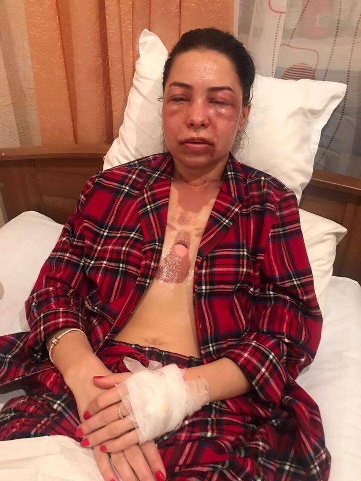 "Зрение повреждено": появились фото женщины, облитой кислотой экс-мужем в Днепре