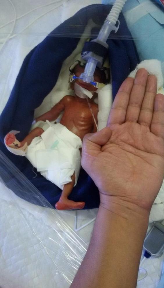 Як долоня: індійські лікарі врятували 400-грамового малюка