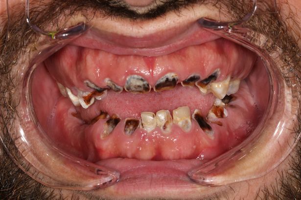 Згнив весь рот: хлопець залишився без зубів через щоденну звичку