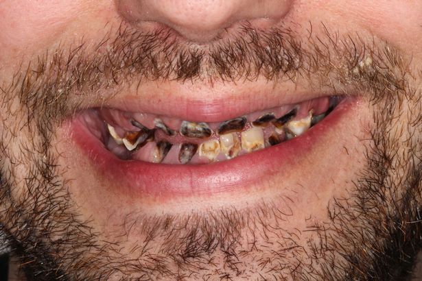 Сгнил весь рот: парень остался без зубов из-за ежедневной привычки